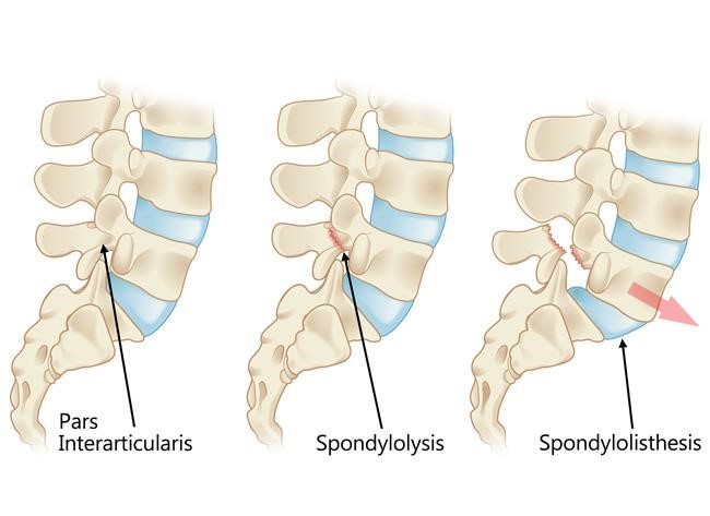 Schéma représentant le pars interarticularis ou isthme vertébral, puis une lyse isthmique puis un spondylolysthésis.