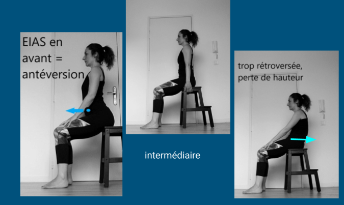 Trois positions du bassin en assise montrant l’antéversion, la position intermédiaire et la rétroversion avec repère de l’EIAS.